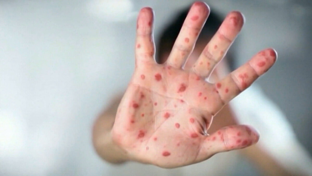 measles returns to the us why 2025s outbreak is raising the alarm p3vwovzmwzd47gfpcrxyvyeuo4