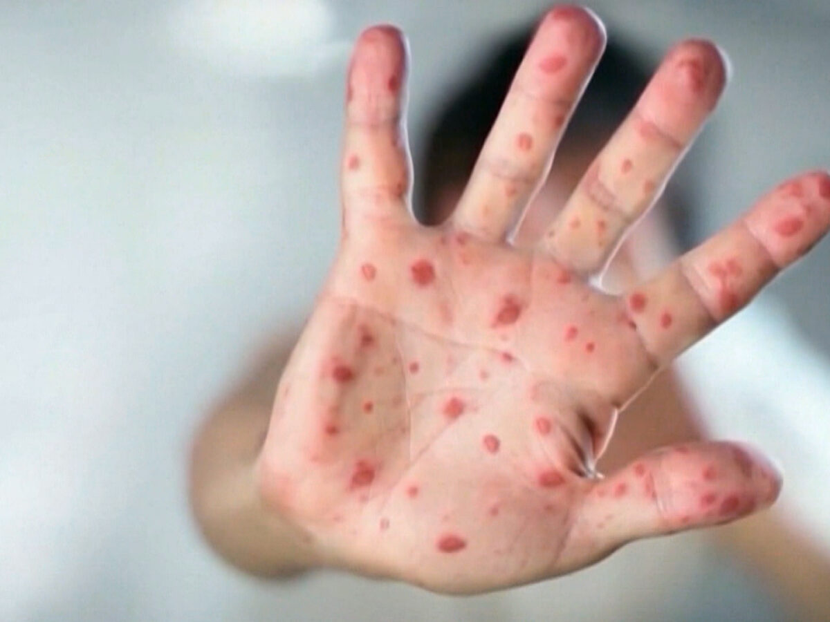 Measles Returns to the US: Why 2025’s Outbreak Is Raising the Alarm